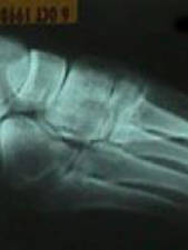 3rd Metatarsal Fracture (Lateral View)