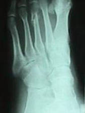 3rd Metatarsal Fracture (Oblique View)