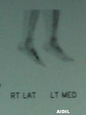 Bone Scan of 3rd Metatarsal Stress Fracture (Lateral Right / Medial Left View)