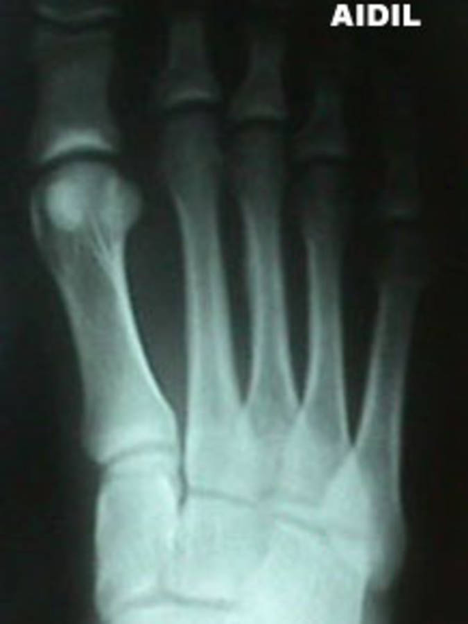 X-Ray of 3rd Metatarsal Stress Fracture (Anterior View)