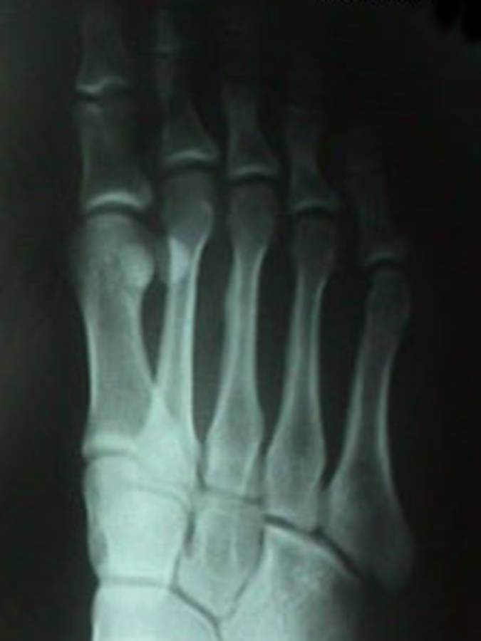 X-Ray of 3rd Metatarsal Stress Fracture (Plantar View)