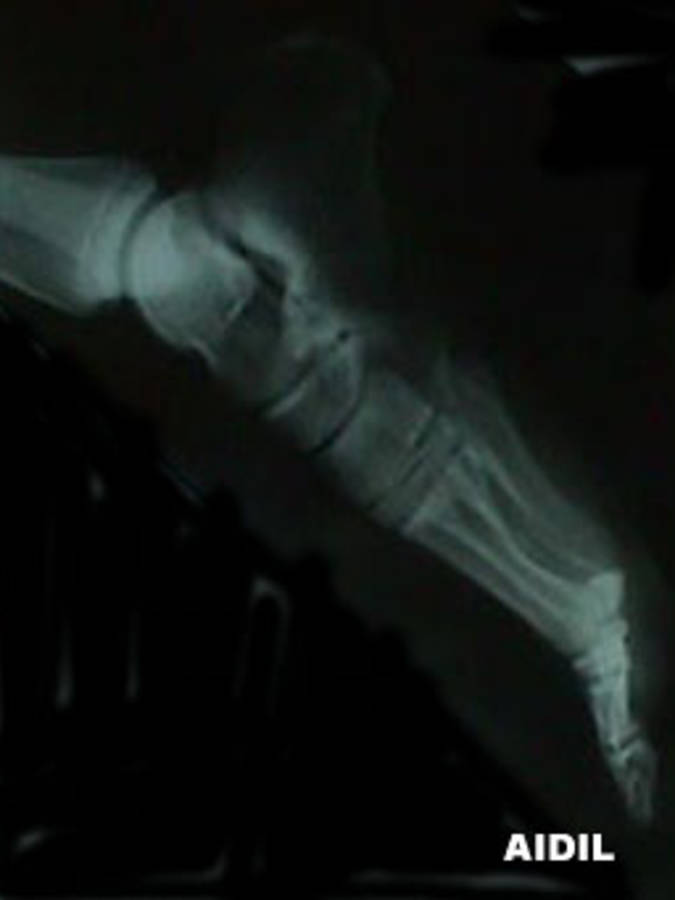 X-Ray of 3rd Metatarsal Stress Fracture (Lateral View)