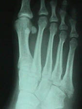 5th Metatarsal Fracture (Oblique View)