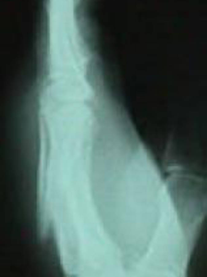 3rd and 4th Metacarpal (Lateral View)