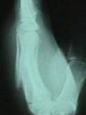 3rd and 4th Metacarpal (Lateral View)