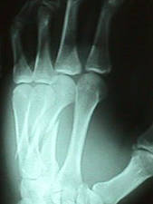 3rd and 4th Metacarpal (Oblique View)