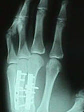 3rd and 4th Metacarpal After Repair (Oblique View)