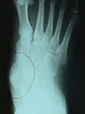 Accessory Navicular (AP View)