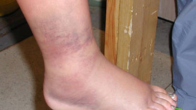 3rd Degree Ankle Sprain 24 hours post-injury (View 2)