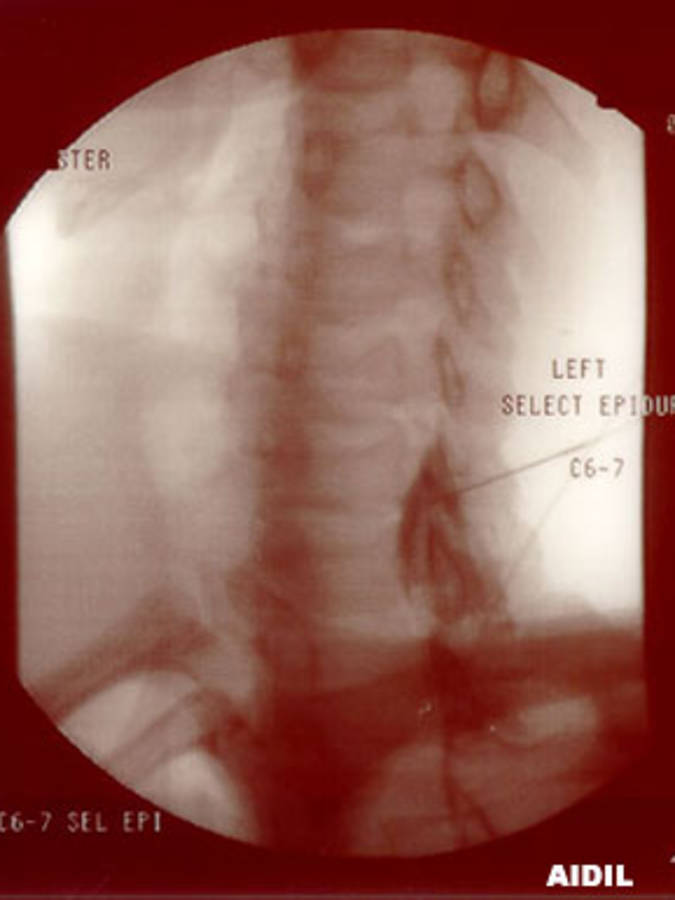 Epidural Injection C6-C7 (Lateral View)