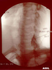 Epidural Injection C6-C7 (Lateral View)