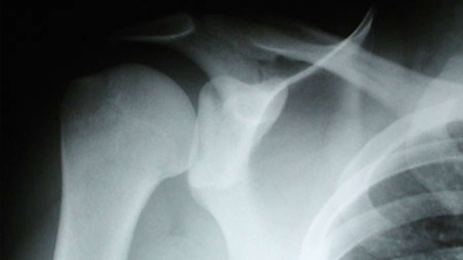 Scapula Fracture (AP with External Rotation View)