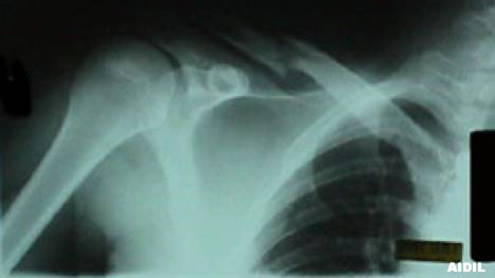 Clavicle Fracture (AP View)