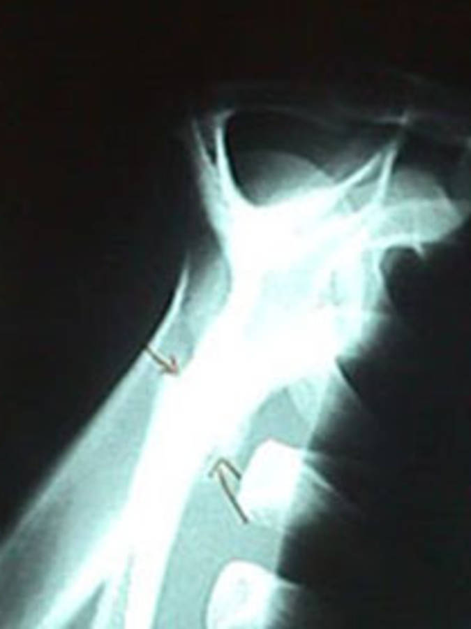Scapula Fracture (Outlet View)