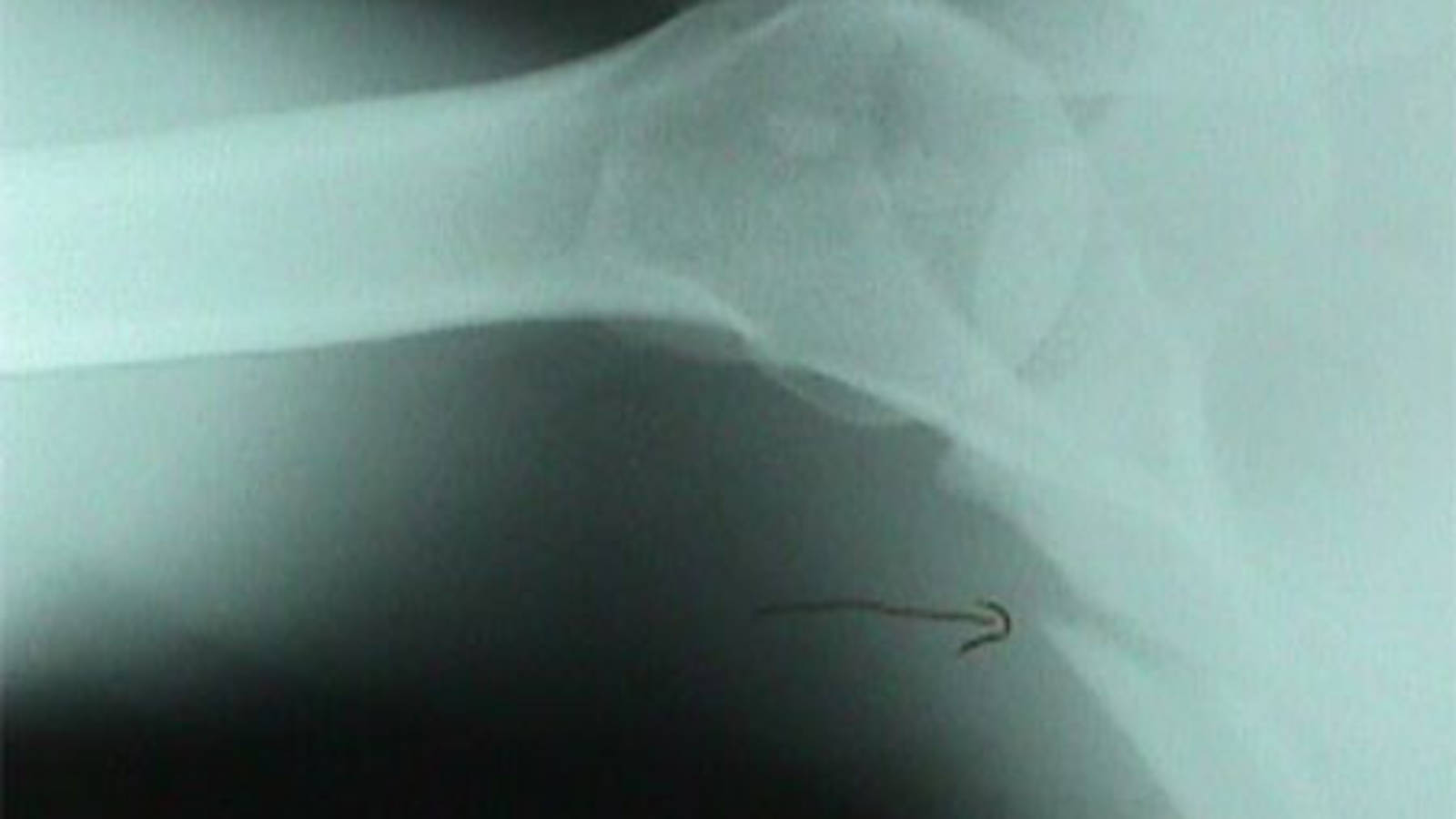 Scapula Fracture (Axillary View)