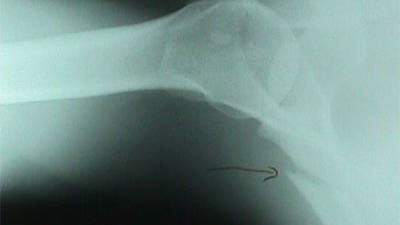 Scapula Fracture (Axillary View)