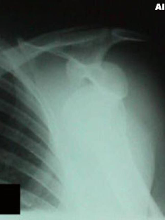 Shoulder Dislocation (AP View 2)