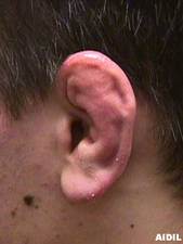 Cauliflower Ear, Chronic (Actual Picture)