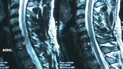 Cervical Spine - Herniated Discs (MRI 1)