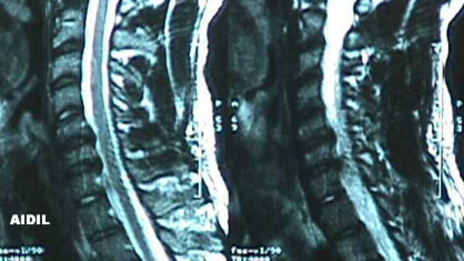 Cervical Spine - Herniated Discs (MRI 2)