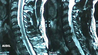 Cervical Spine - Herniated Discs (MRI 2)