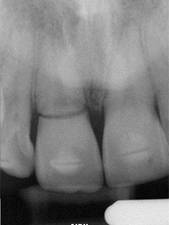 Mouth - Root Fracture