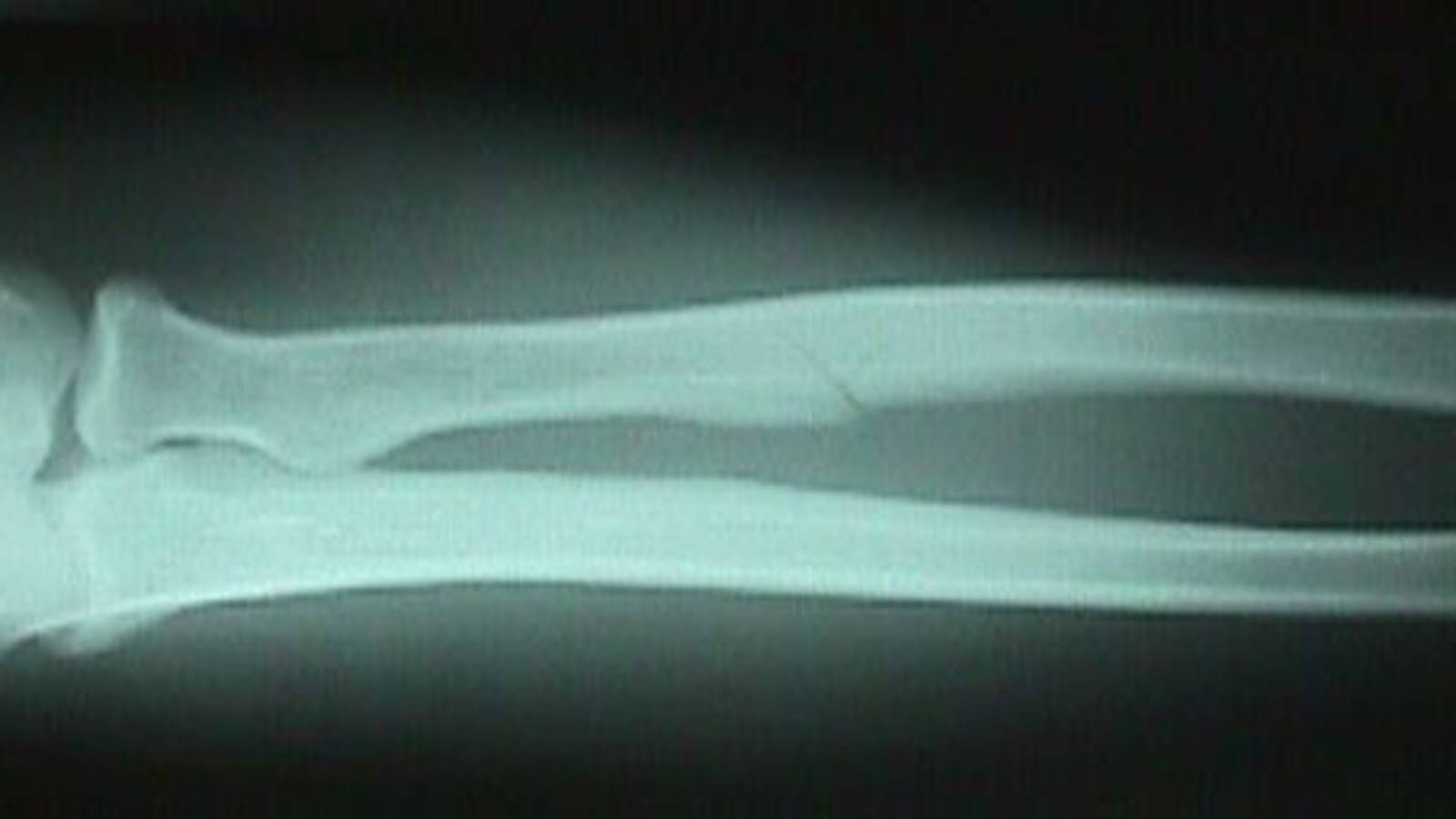 AP View of Radial Fracture