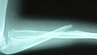 Lateral View of Radius Fracture / Salter-Harris II Humerus Fracture