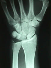 AP View of Lunate Dislocation w/ Ulnar Styloid Fracture