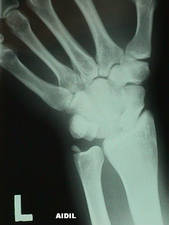 AP View of Lunate Dislocation w/ Ulnar Styloid Fracture and Ulnar Deviation