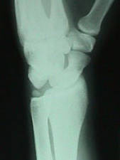 Oblique View of Lunate Dislocation w/ Ulnar Styloid Fracture and Internal Rotation