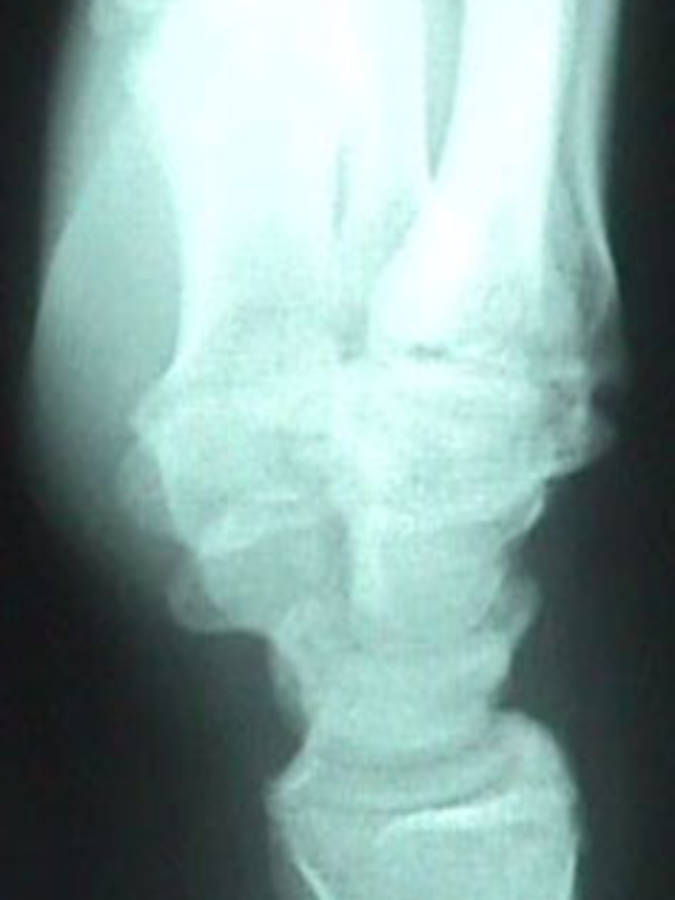 Lateral View of a wrist with a Scaphoid Fracture