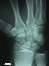 Oblique View of a wrist with a Scaphoid Fracture