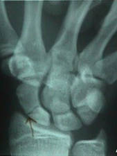 Ulnar Deviation View of a Scaphoid Fracture with closed fist