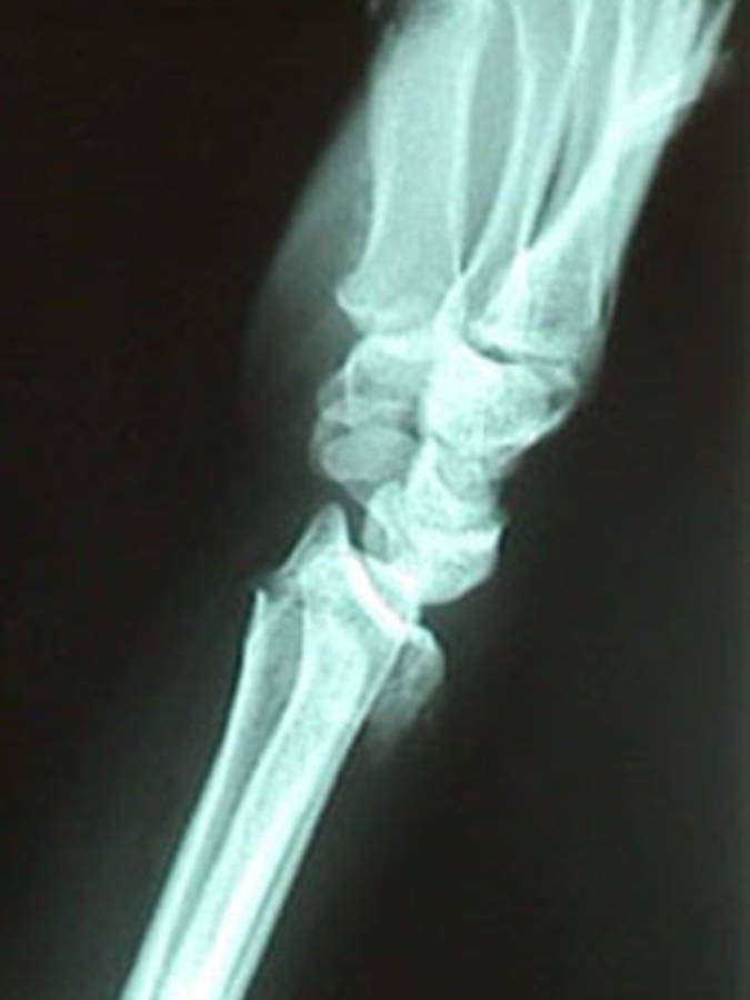 Lateral View of Colles Fracture