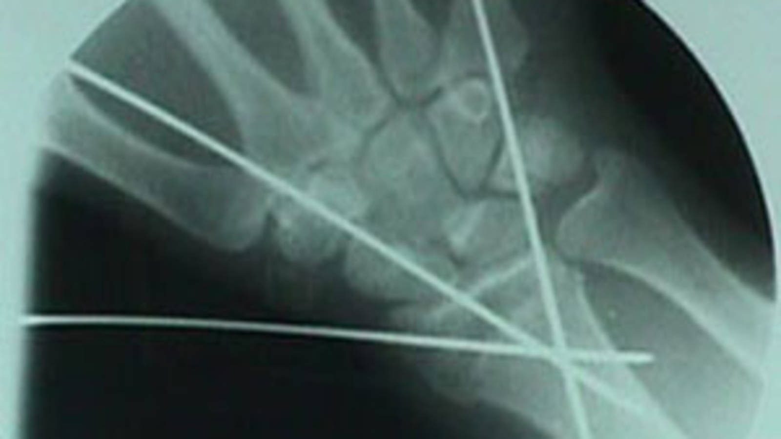 AP View of Colles Fracture After Repair