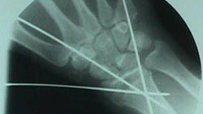 AP View of Colles Fracture After Repair
