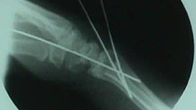 Lateral View of Colles Fracture After Repair