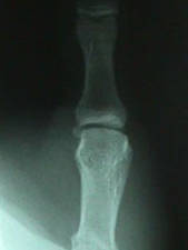 Oblique View of Thumb Fracture