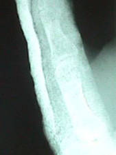 Oblique View Thumb Dislocation Reduced/Splinted