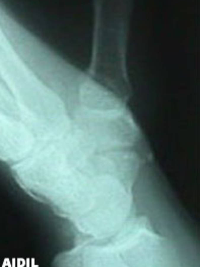 AP View of Thumb Fracture