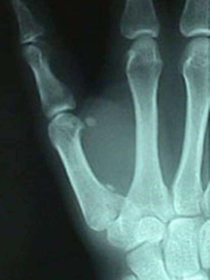 Oblique View of Thumb Fracture