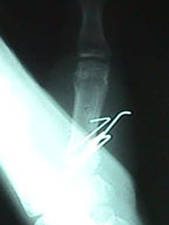 AP View Thumb Fracture After Repair