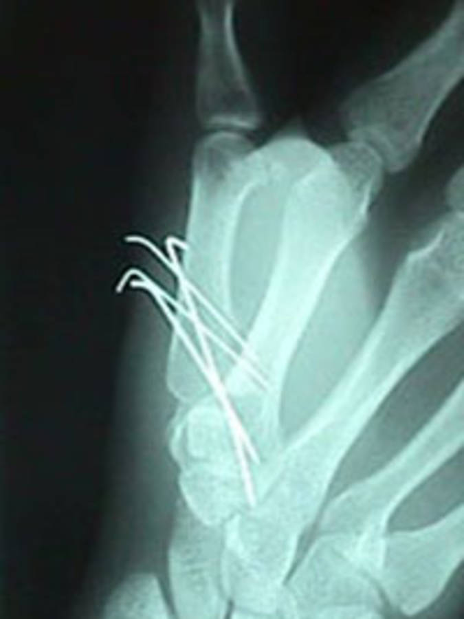 Lateral View Thumb Fracture After Repair