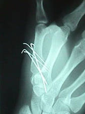 Lateral View Thumb Fracture After Repair