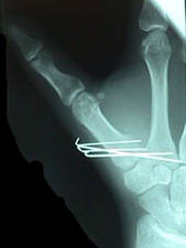 Oblique View of Lateral View Thumb Fracture After Repair