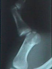 Oblique View of Dislocated Thumb