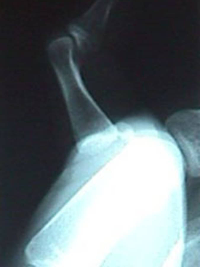 AP View of Dislocated Thumb