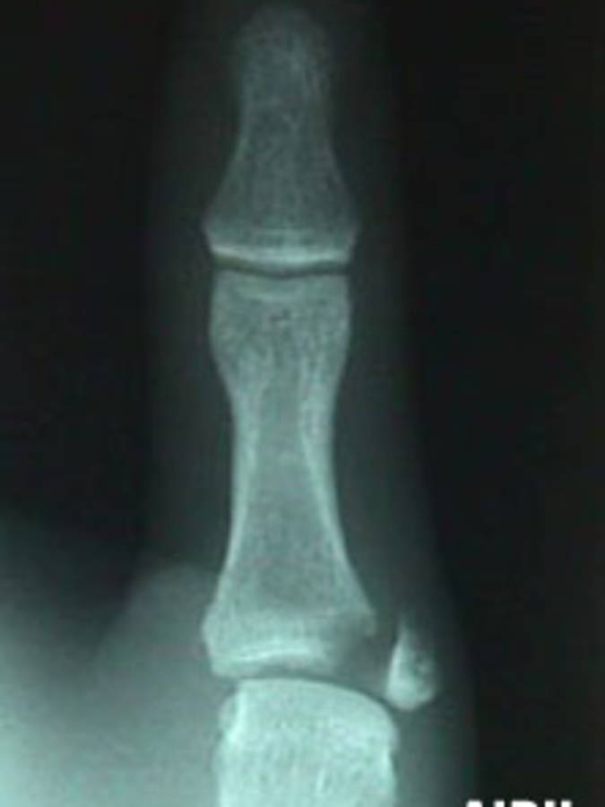 AP View of Thumb Fracture