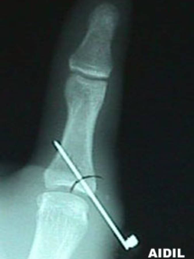 AP View of Thumb Fracture After Repair